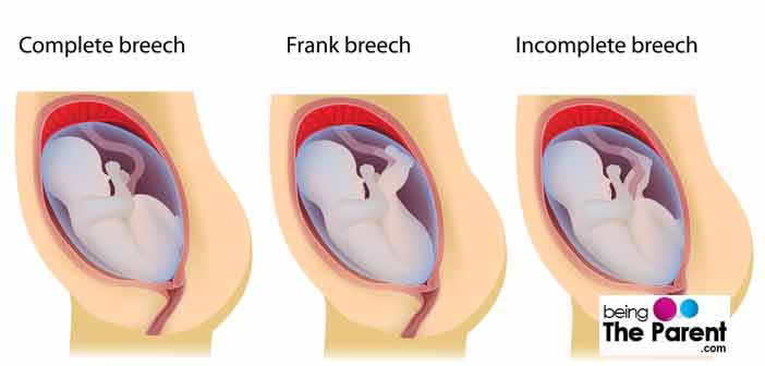 Cephalic presentation at 35 weeks