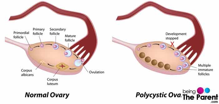 Polycystic Ovary Syndrome-Causes, Symptoms, Diagnosis and ...
