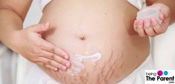 remedies for stretch marks