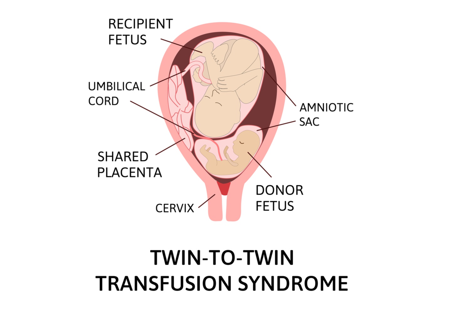 Twin-To-Twin Transfusion Syndrome