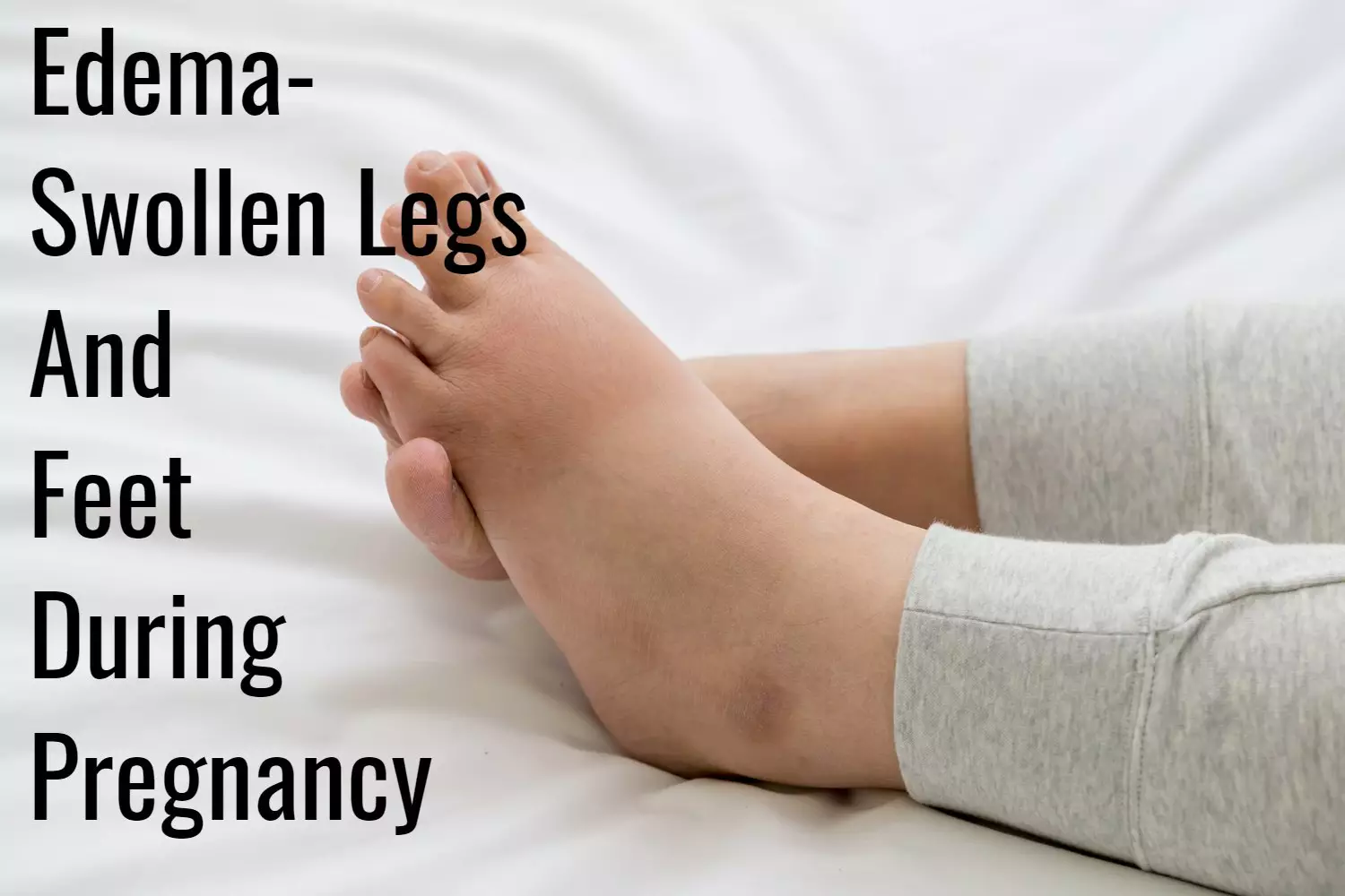 Swollen Legs and Feet during Pregnancy