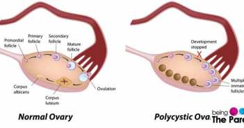 Polycystic Ovary Syndrome-Causes, Symptoms, Diagnosis and Treatment PCOS Ovary