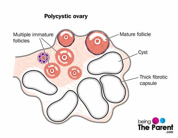 PCOS-Ovary