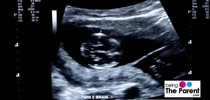 Twins during ultrasound