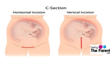 Bleeding and Breastfeeding After A C-Section C-Section Incision