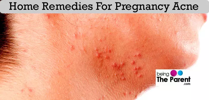 Treating Pregnancy Acne With Home Remedies | Being The Parent