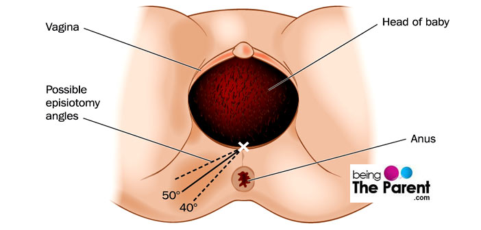 Episiotomy angles