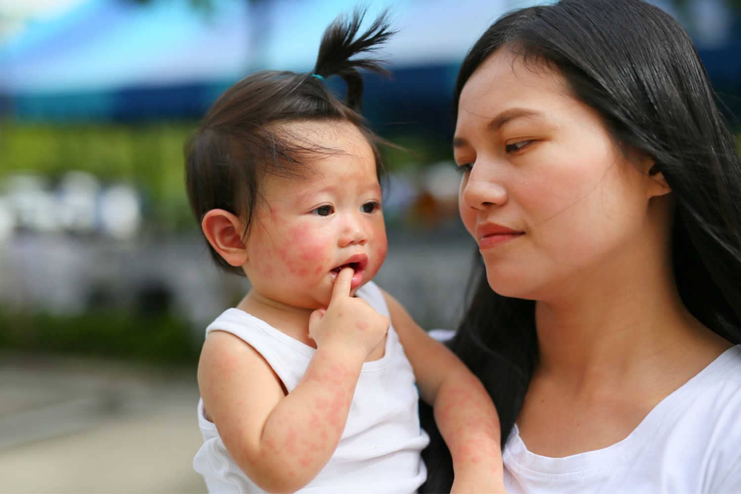 Allergens Can Be Responsible For Baby Eczema.