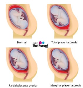 Types-of-placenta-previa
