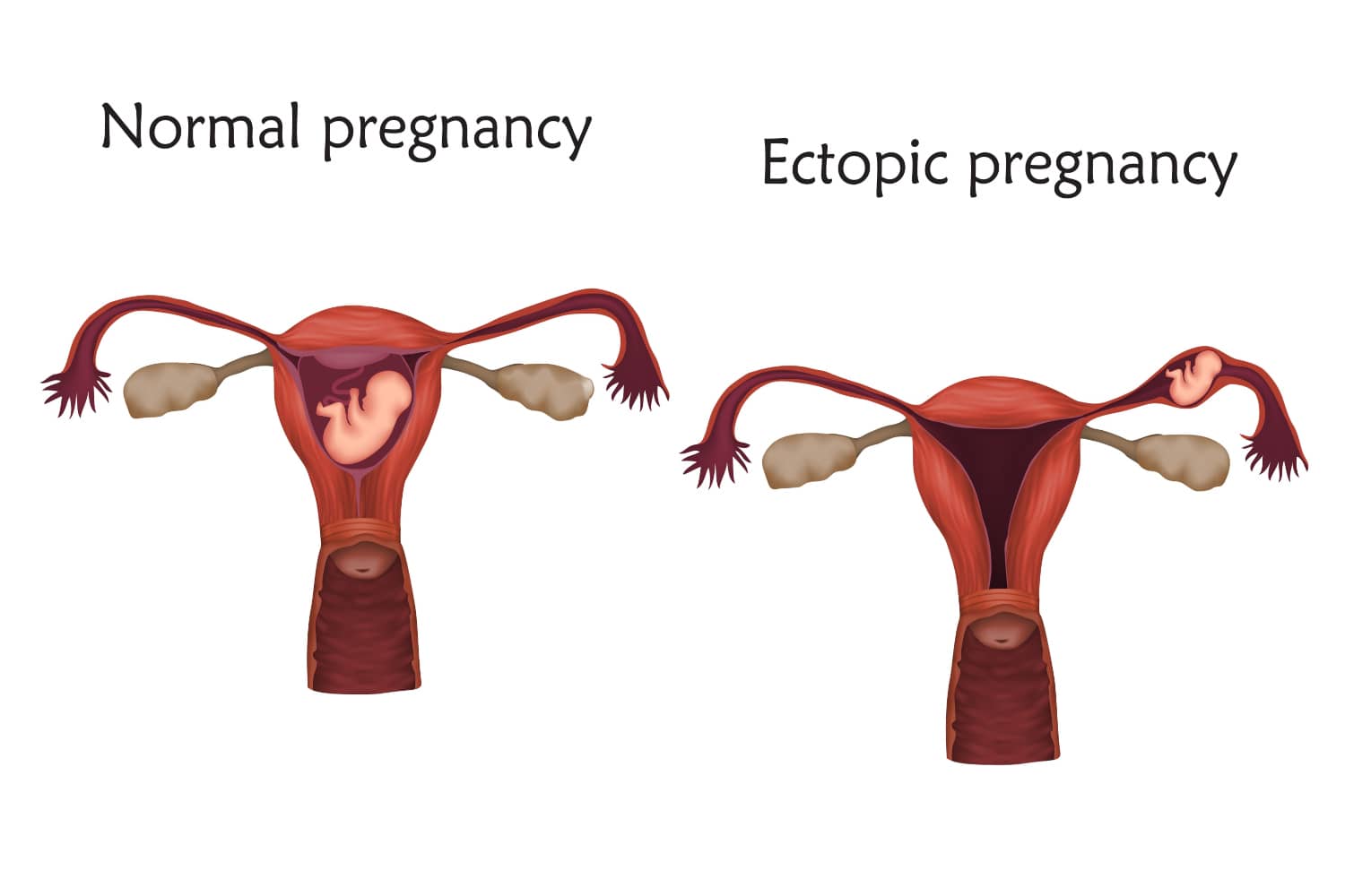 What Are the Probable Causes of Ectopic Pregnancy