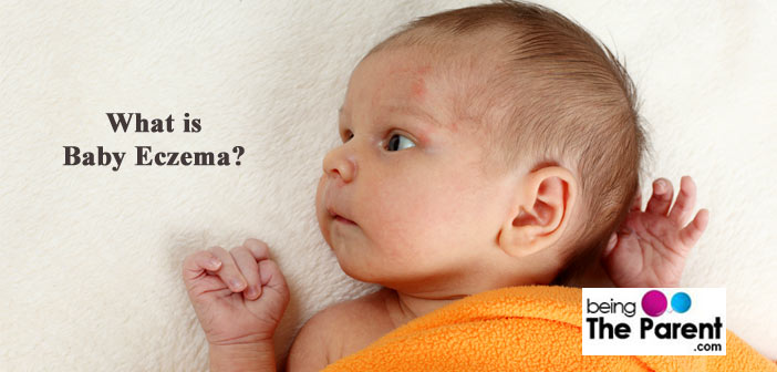 Baby eczema