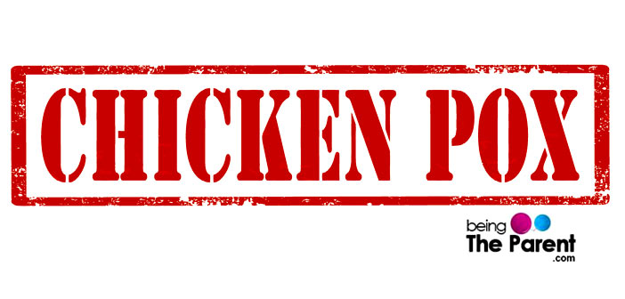 Chicken pox in pregnancy