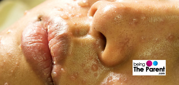 Chicken pox in pregnancy