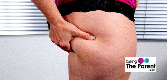 Cellulite in thighs