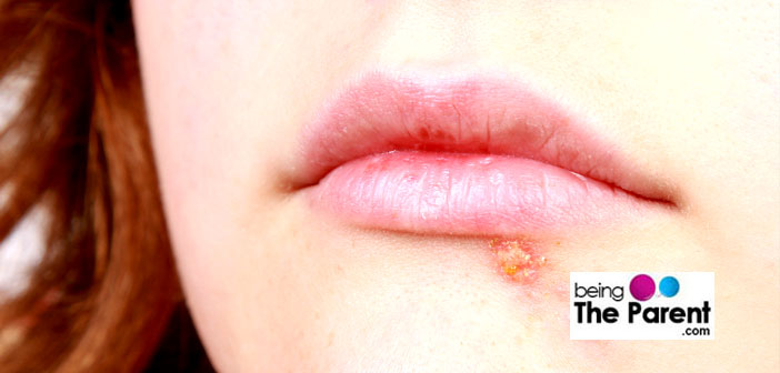 Impetigo blister