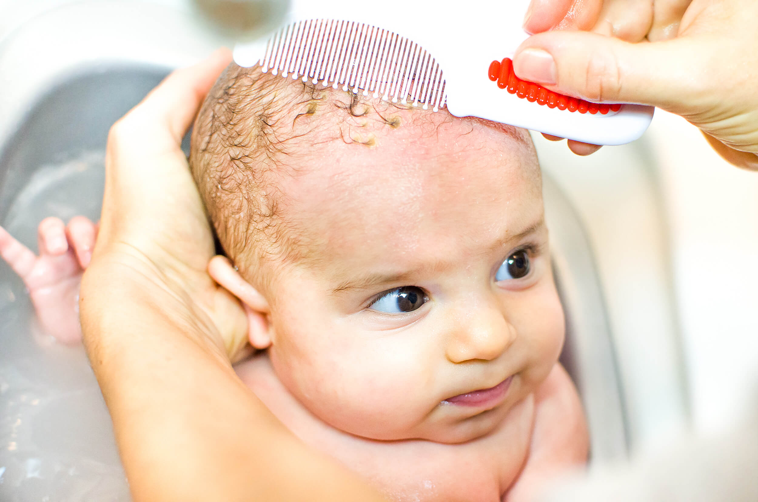 Cradle Cap In Babies Being The Parent