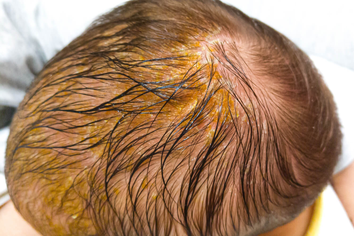Cradle Cap In Medical Definition at Scott Harms blog