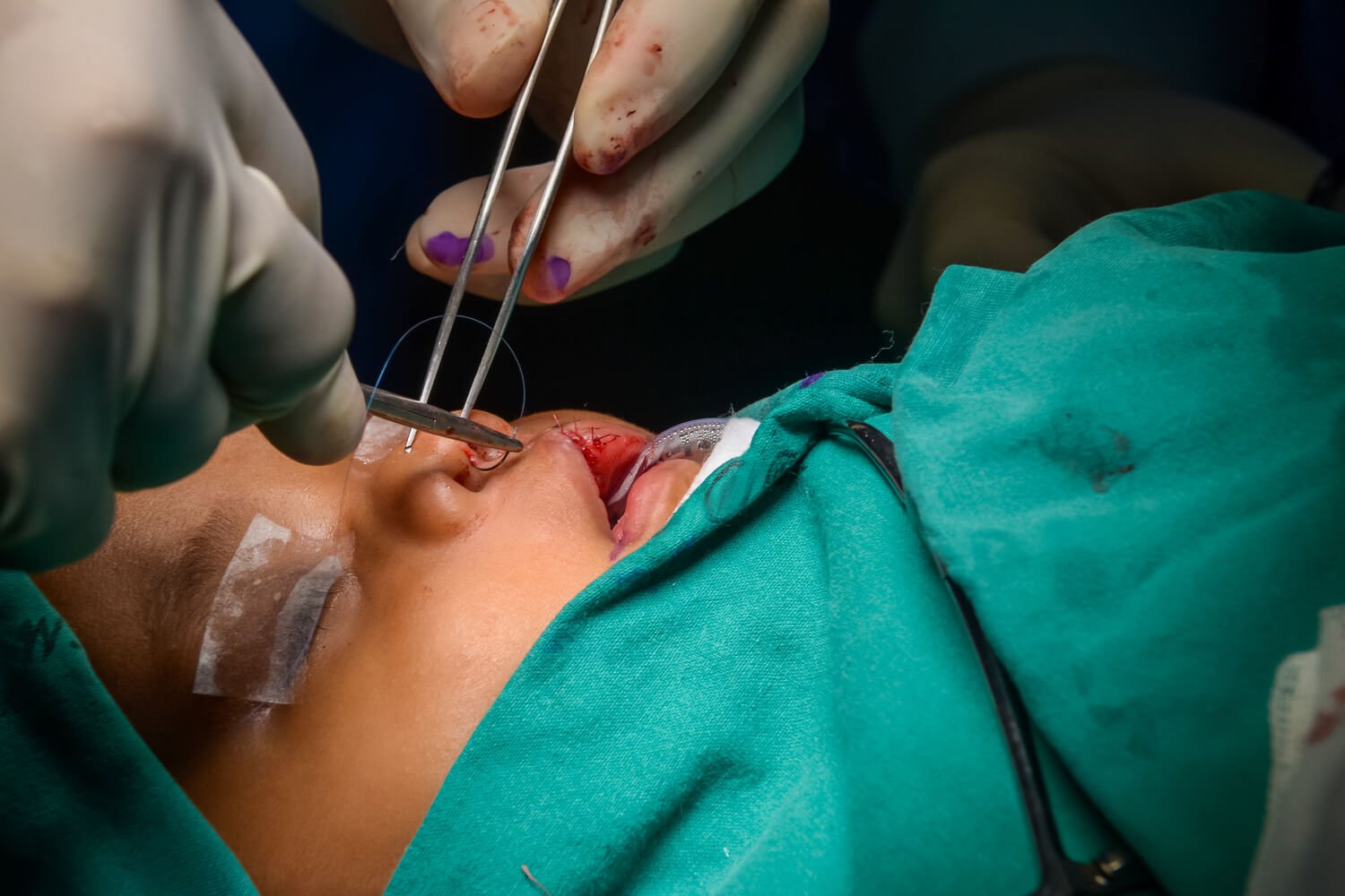 surgery to treat cleft lip