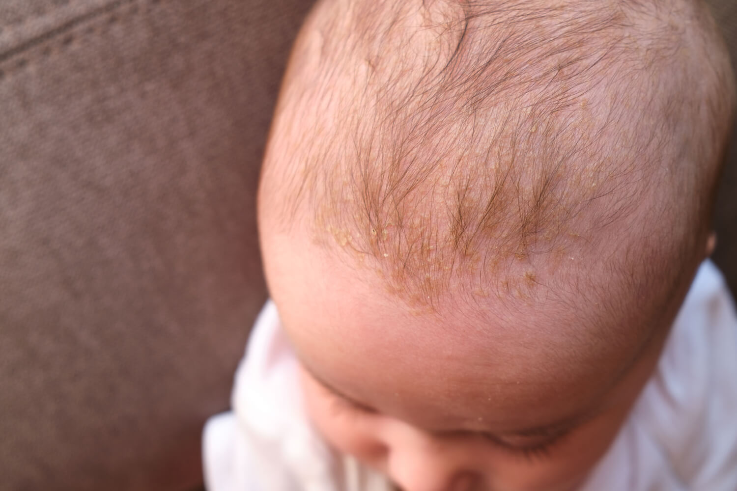 Cradle Cap In Babies Being The Parent