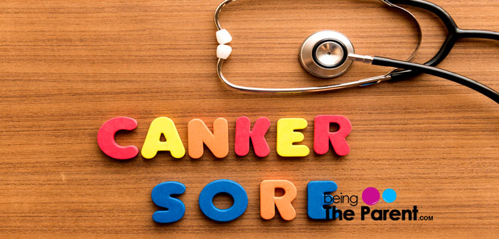 Canker sore treatment