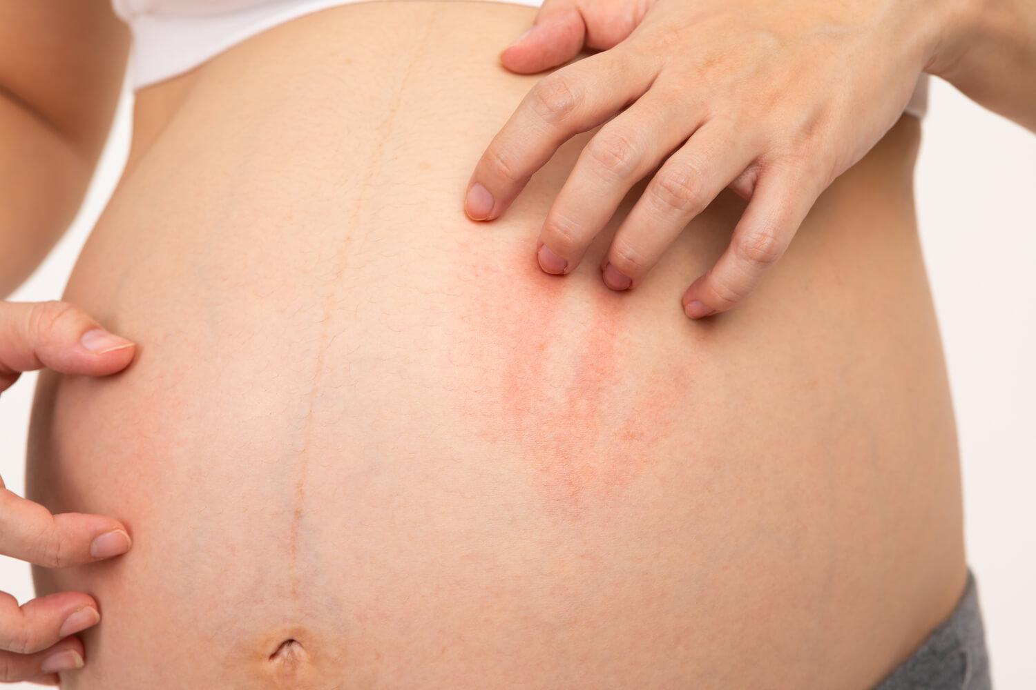 Itchy Skin in Second Trimester