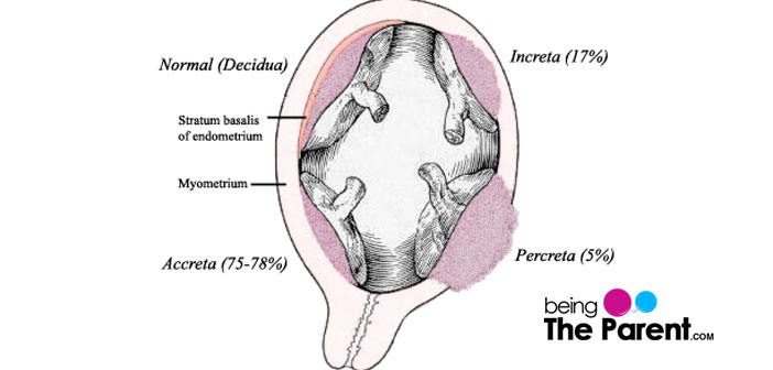 Placenta Accreta