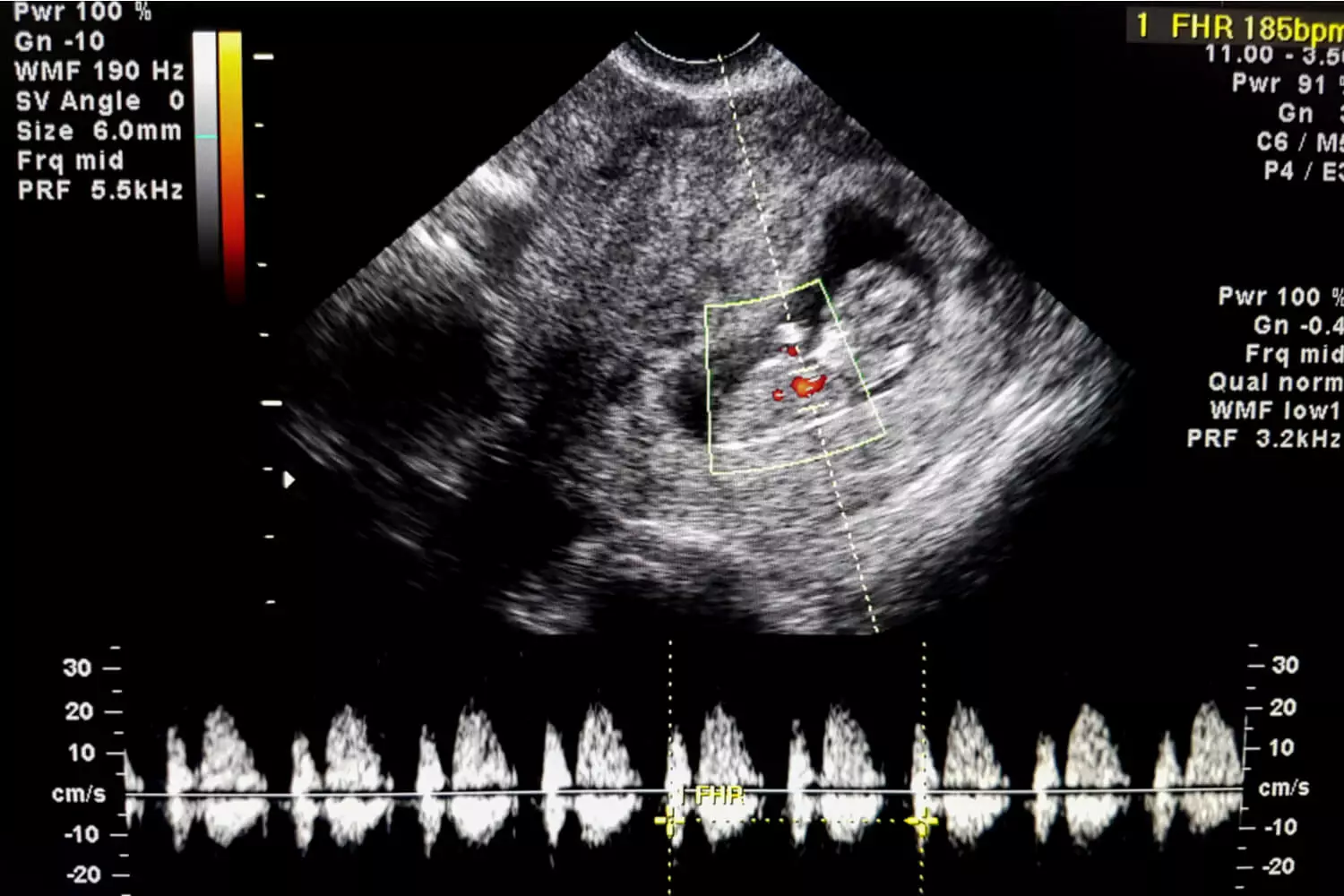 fetal heart rate in ultrasound