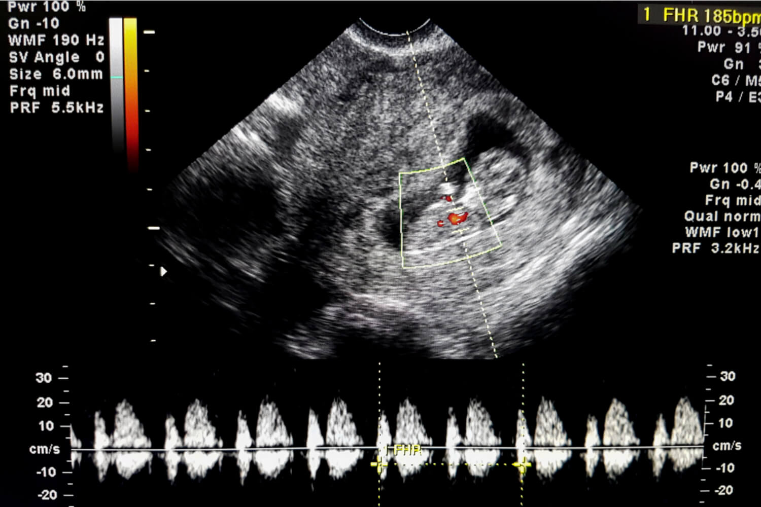 baby girl heart rate