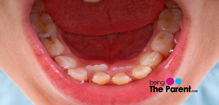 Hyperdontia in children