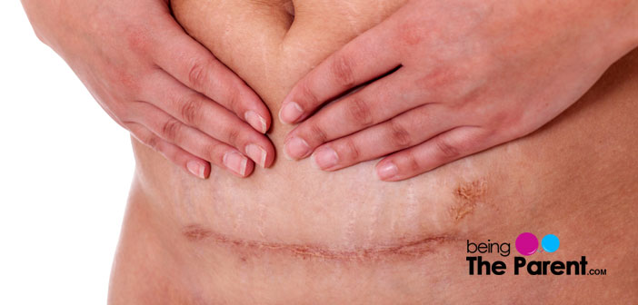 C-section scar