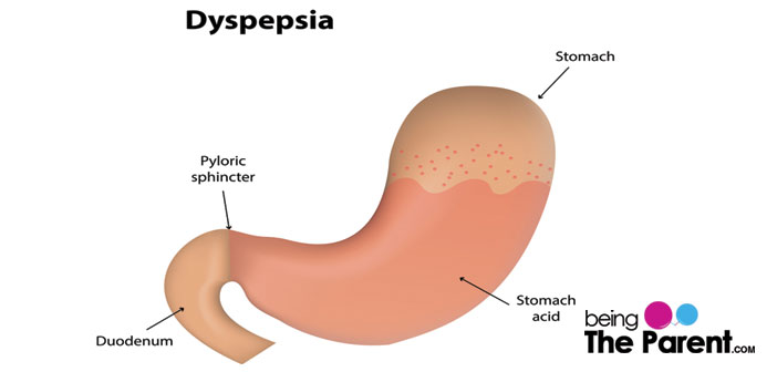 Dyspepsia