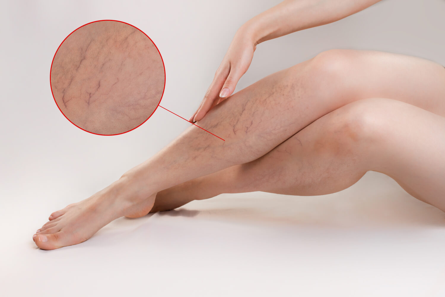 Varicose veins in women