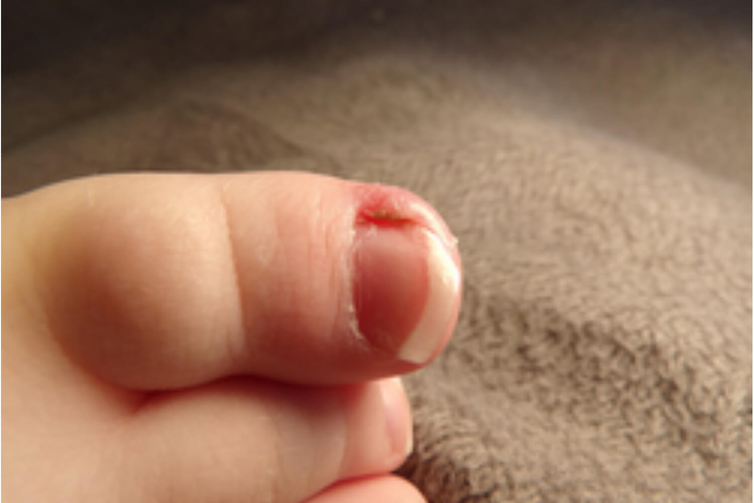 ingrown toe nails in baby