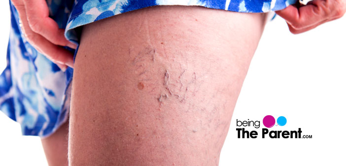 Varicose veins - Symptoms and causes - Mayo Clinic