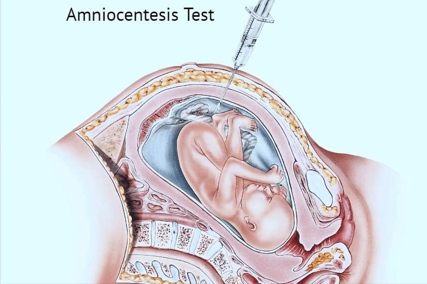 amniocentesis test