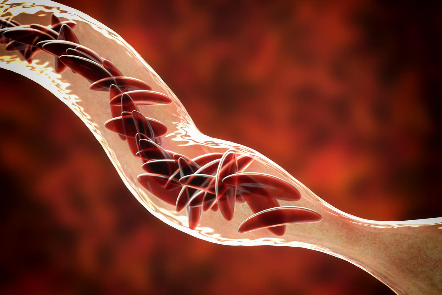 sickle cell anemia