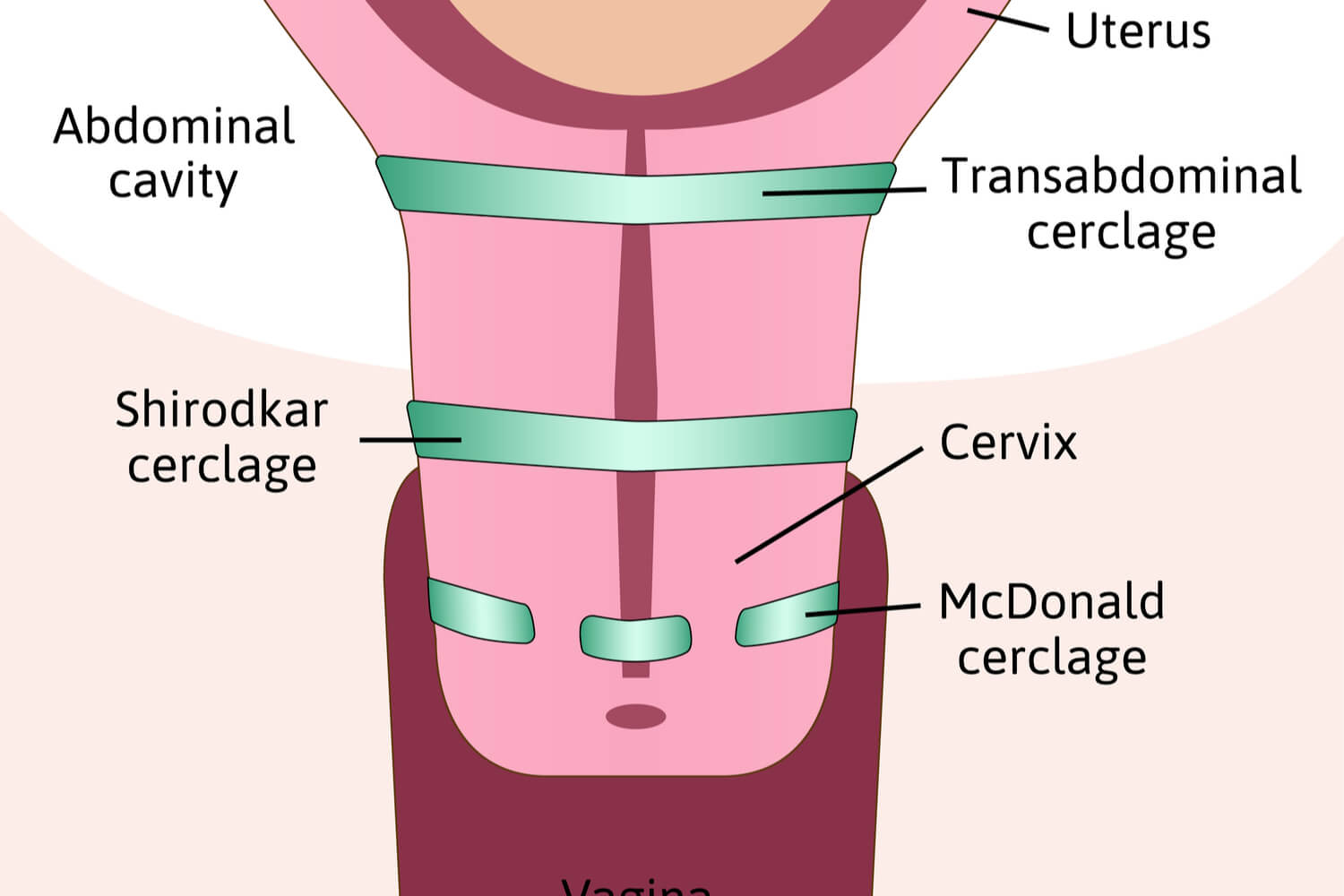 Cerclage