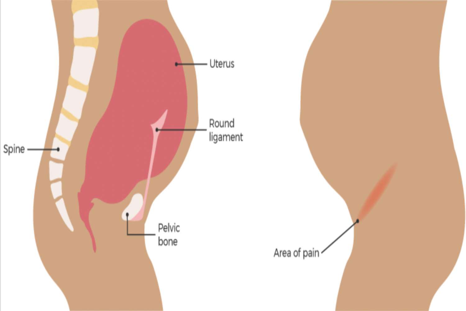 Round Ligament Pain During Pregnancy_