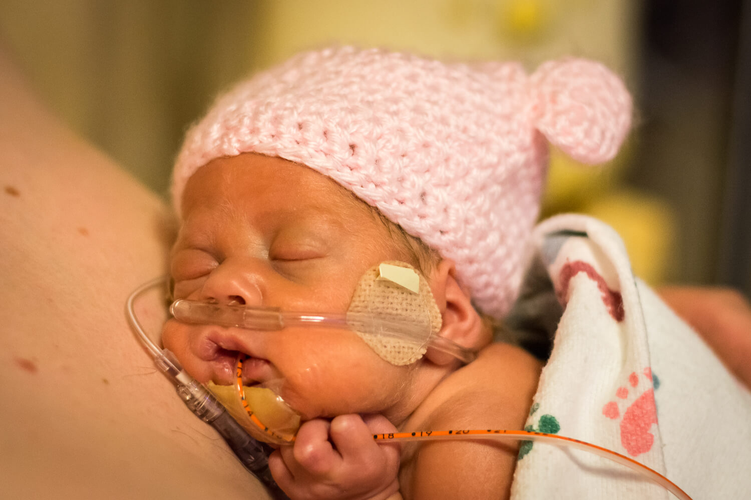 What Complications Can Be Experienced By A Premature Newborn_