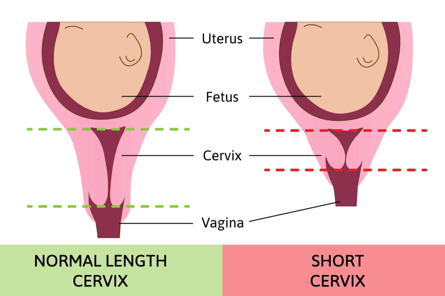 Cervical Length