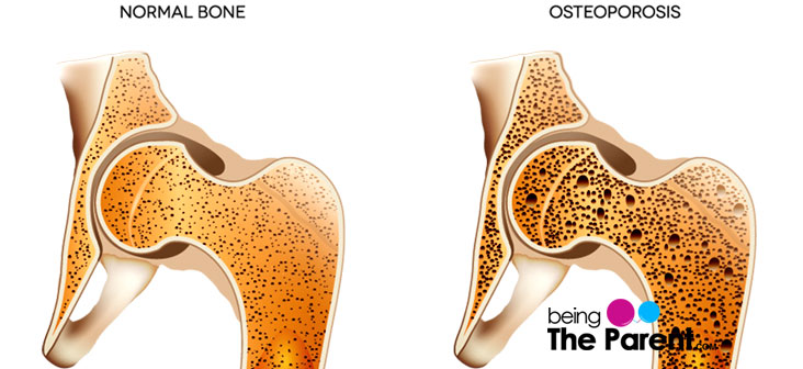 Osteoporosis and Pregnancy