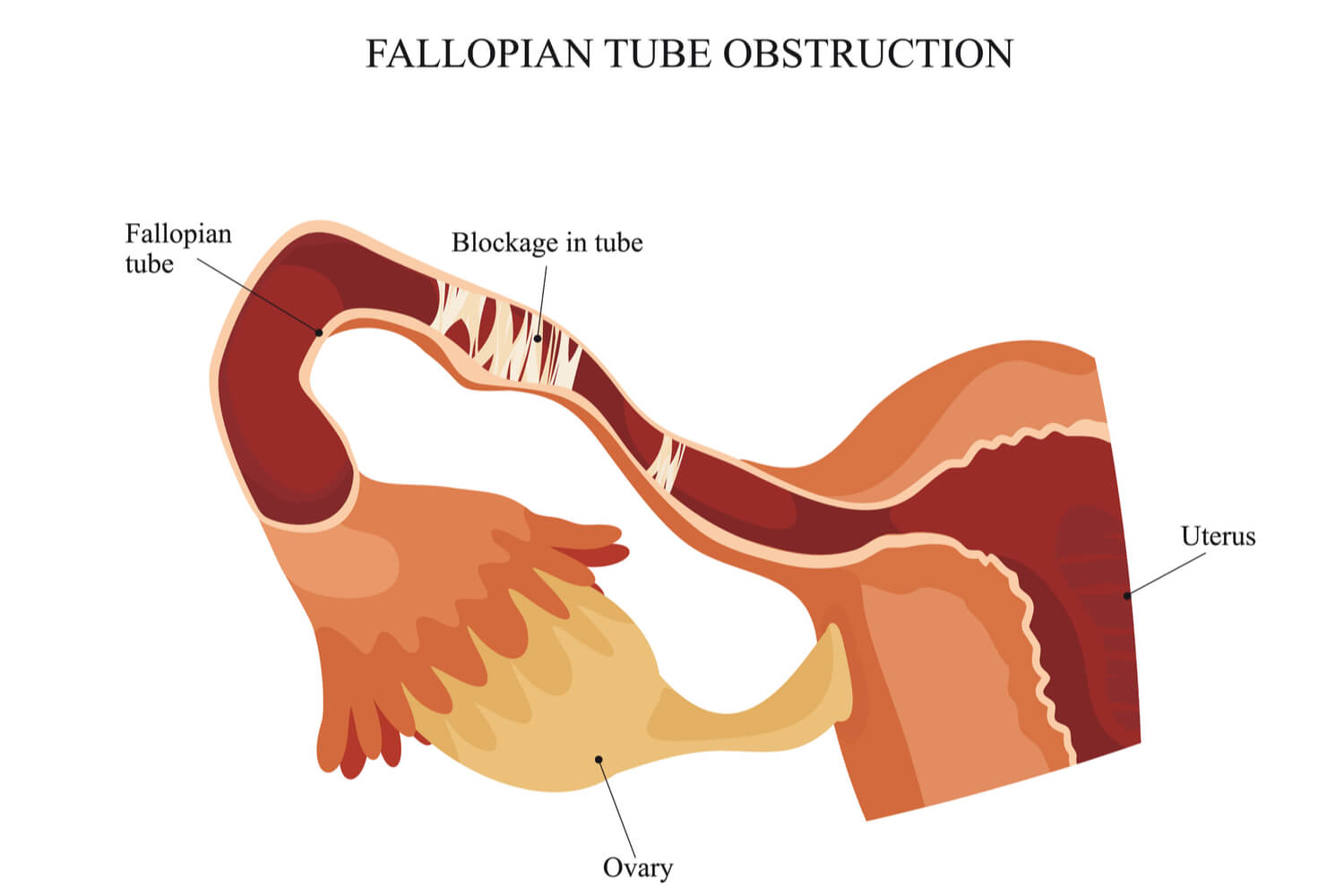Blocked Fallopian Tubes Types, Causes And Treatments Being The Parent