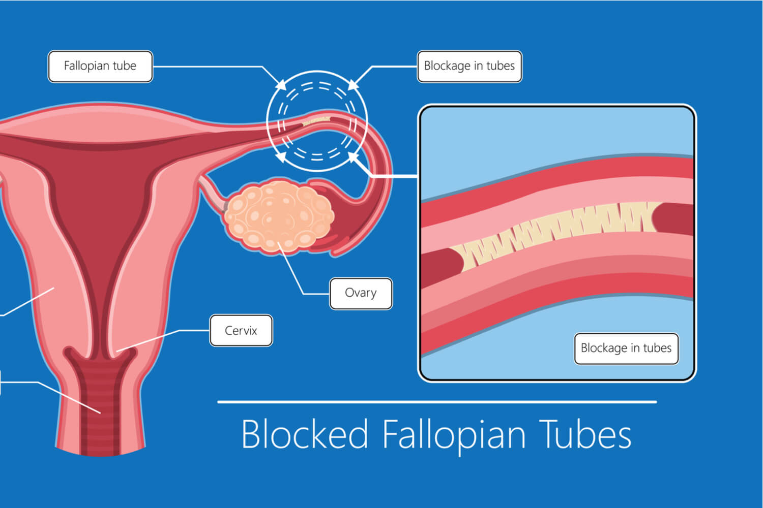 Blocked Fallopian Tubes Types Causes And Treatments Being The Parent