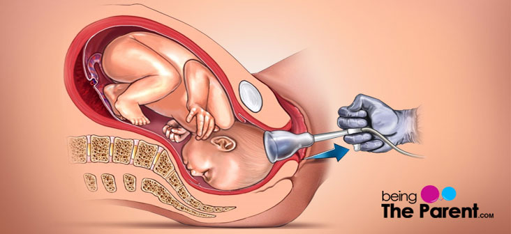 vacuum assisted birth everything you need to know being the parent vacuum delivery