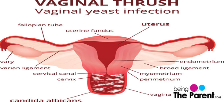 What Are The Symptoms Of Thrush, What Causes Oral And Vaginal Yeast Infections, How Is It Treated And Can Men Get It