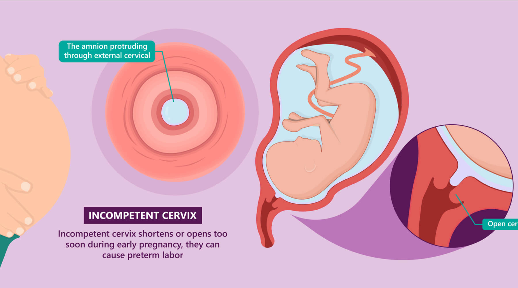 Complications With The Cervix During Labor