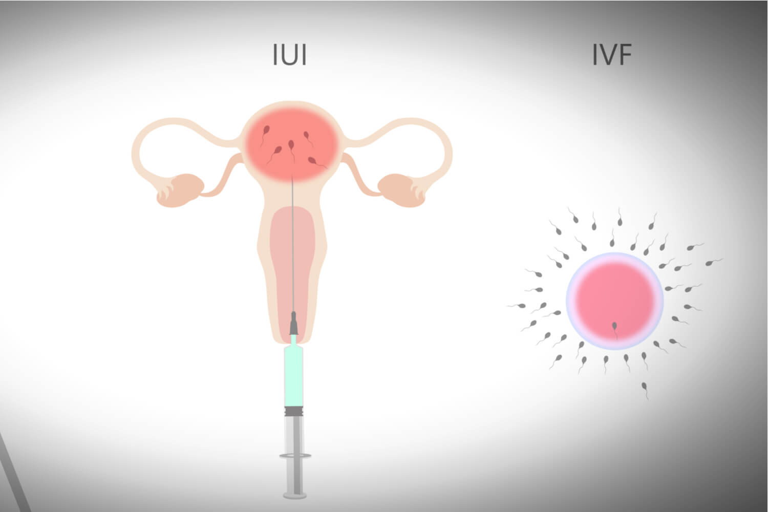 IVF and IUI