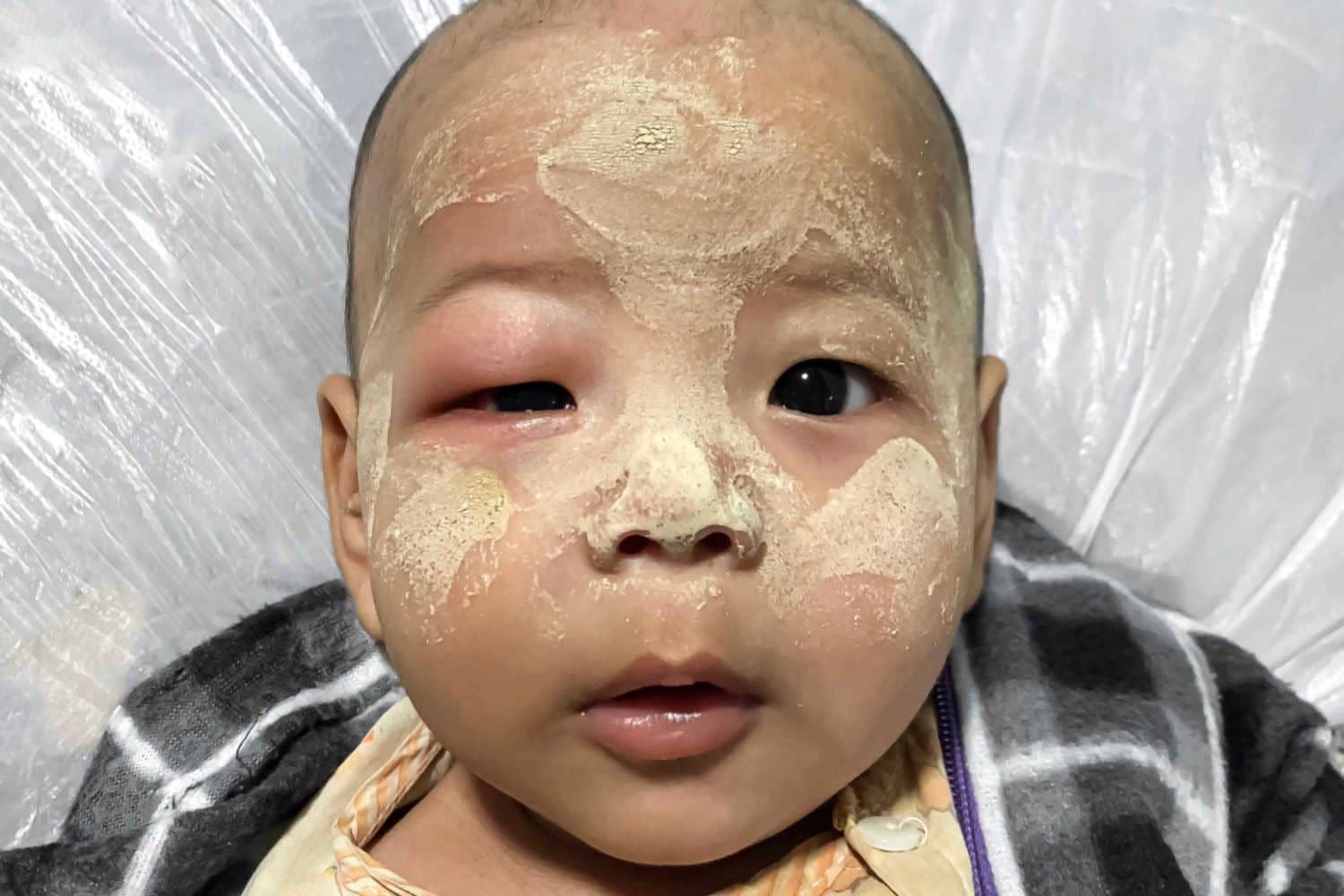 Angioedema in baby