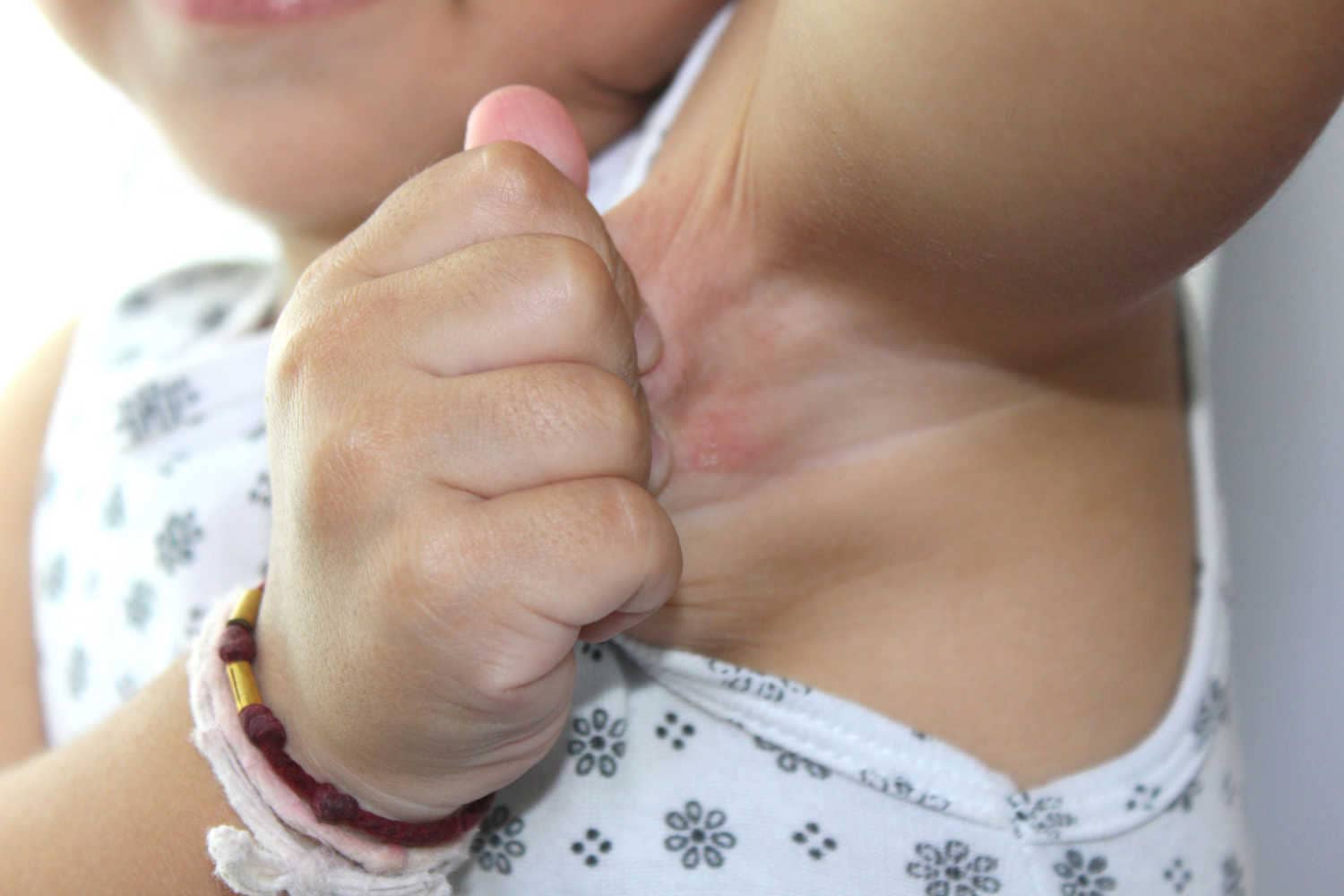 Causes of fungal infection in babies
