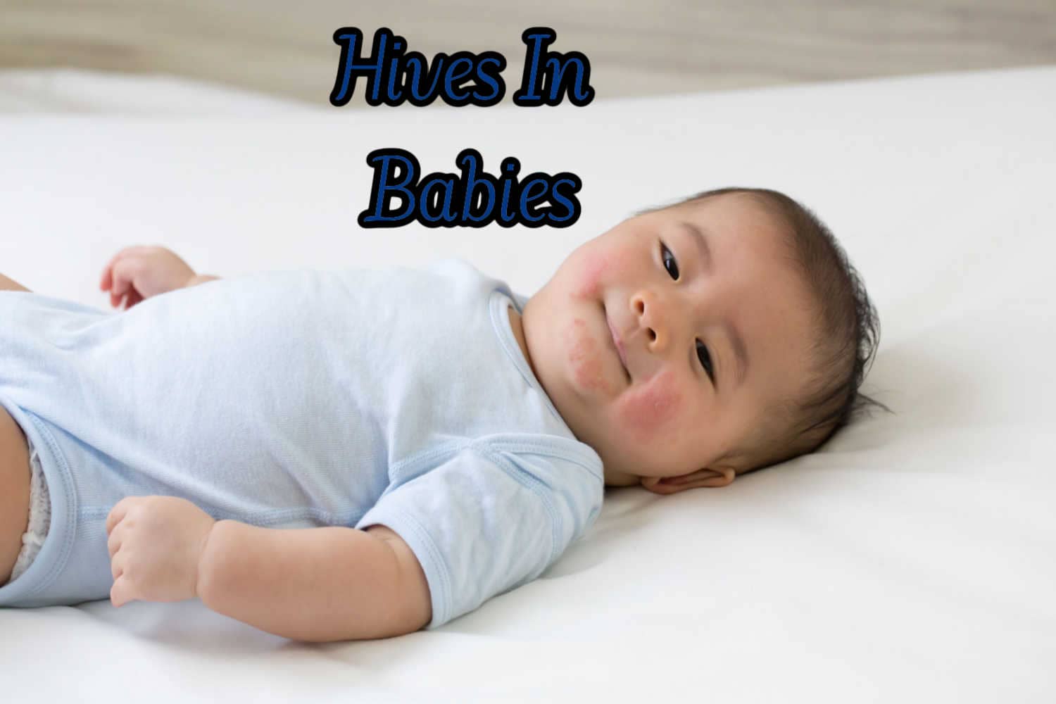 Hives In Babies